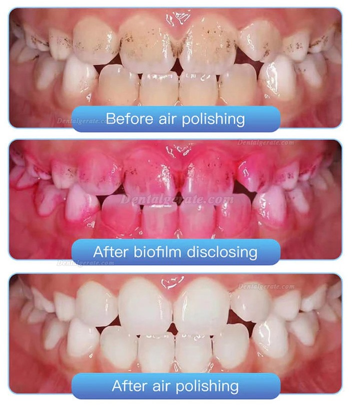 Dental Pulverstrahlger&auml;t Ganzmetall-Zahnpolierer 2/4 Loch